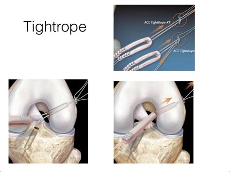 Acl graft fixation options