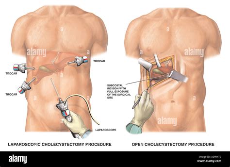 Gallbladder operation hi-res stock photography and images - Alamy