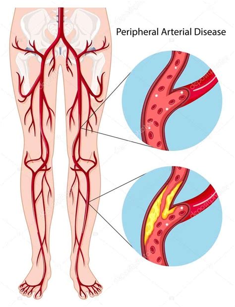 Claudication - Peripheral Arterial Disease | Coastal Vascular Center