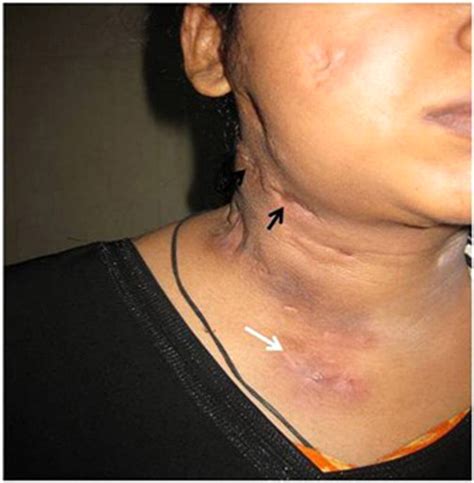 Hiv And Lymphadenopathy Swollen Lymph Nodes - vrogue.co