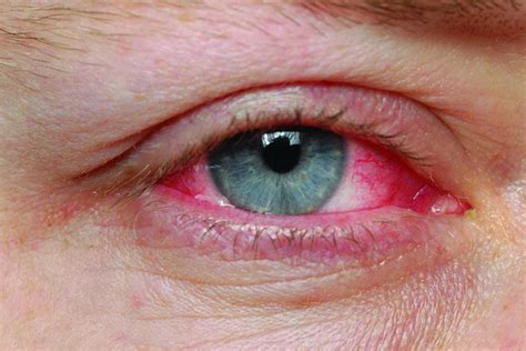 Pink Eye: Symptoms, Causes, Types & Treatment » How To Relief
