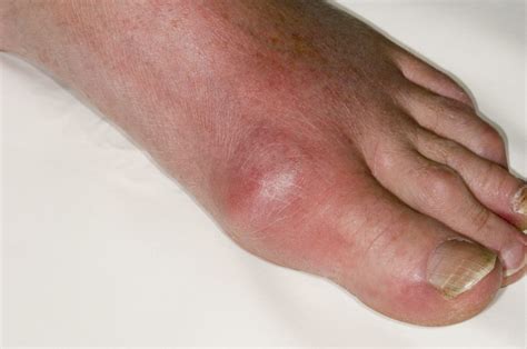 Treatment and management of gout: the role of pharmacy - The ...