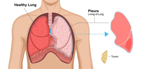 Pleurectomy and Decortication (P/D) | Mesothelioma Surgery