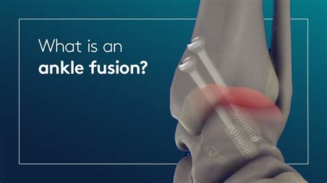 What is an ankle fusion? - YouTube