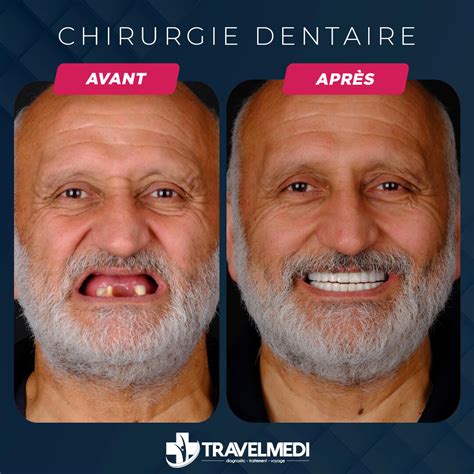 Chirurgie Dentaire en Turquie - Coût, Avant-Après 2024