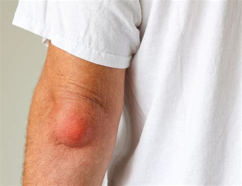 Signs Elbow Bursitis Is Causing Your Elbow Pain and Swelling