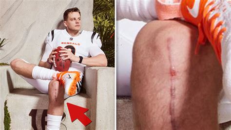 Joe Burrow's Huge, Gnarly ACL Surgery Scar Shown During Bengals' Jersey ...