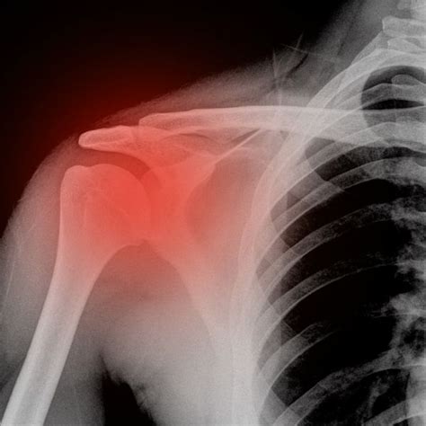 Shoulder Fracture | Shoulder Specialist | South Windsor, Rocky Hill, Glastonbury CT