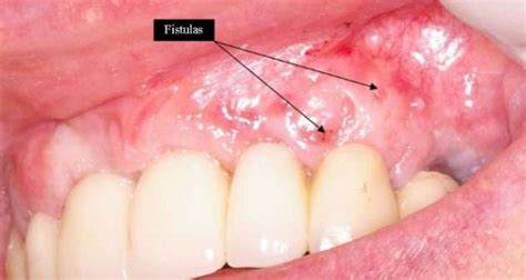 Fístula dental: características, causas e alternativas de tratamento - Educar Saúde