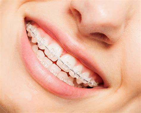 Clear Braces: What You Need To Know – Fidt