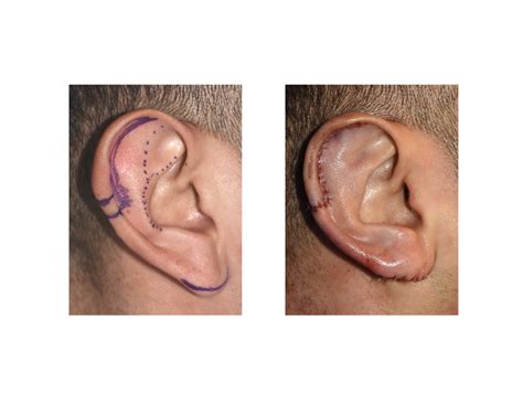 Plastic Surgery Case Study - Macrotia Ear Reduction - Explore Plastic Surgery