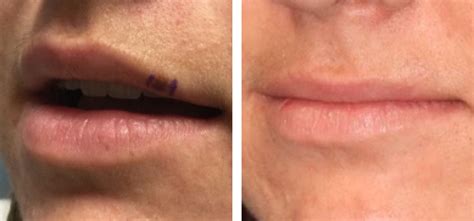 Pictures Of Melanoma On Lips | Lipstutorial.org