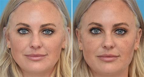 Injectable Fillers photos - Becker Plastic Surgery