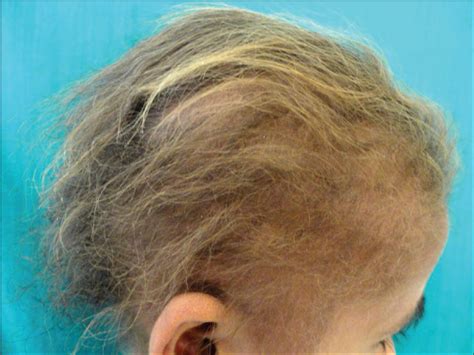 Uncombable hair syndrome with a woolly hair nevus - Indian Journal of ...