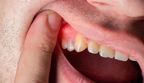 Dental Abscess : Causes, Symptoms, and Prevention