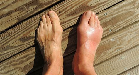 How to tell you have gout – and how to avoid it
