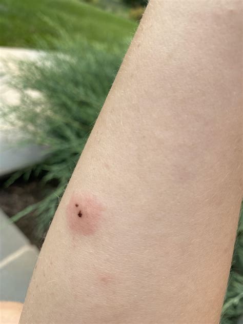 Is this a brown recluse bite? 3 days in, after cleaning off some gunk... : BrownRecluseBites