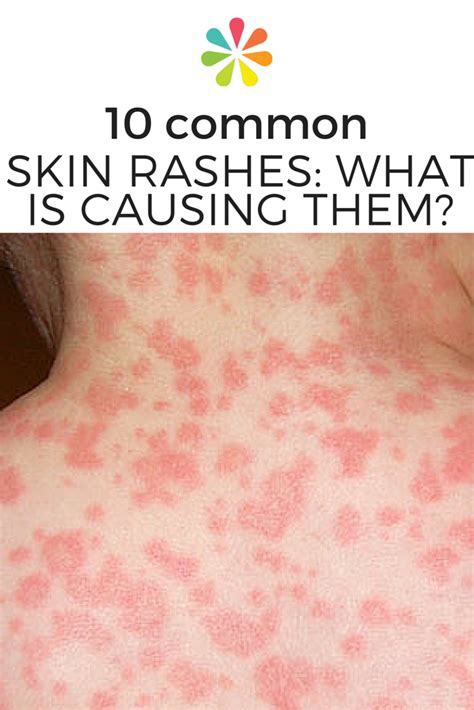 What's Causing Your Skin Rash? | Skin rash, Common skin rashes, Skin rashes pictures