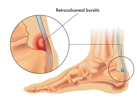 Achilles Bursitis - Rehab 49