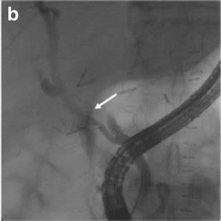 Biliary complications are categorized as an a isolated stricture, b ...