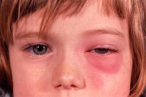 Orbital Cellulitis Eyewiki | My XXX Hot Girl