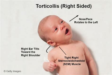 What you need to know about torticollis - Performance Optimal Health