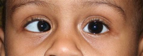 Strabismus - American Association for Pediatric Ophthalmology and Strabismus