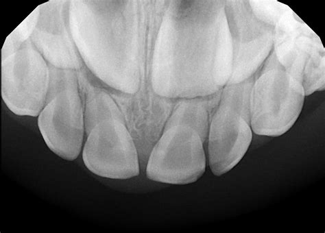 Dental X-Rays: The Whole Tooth – Pediatric Dental Blog