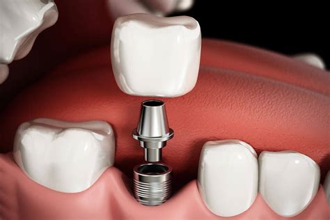 Loose Dental Implant Crown | Atlas Dental, Toronto Dentist
