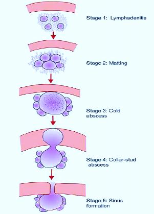 O C & P - COLD ABSCESS - Dr. Meenesh Juvekar - ENT Specialist