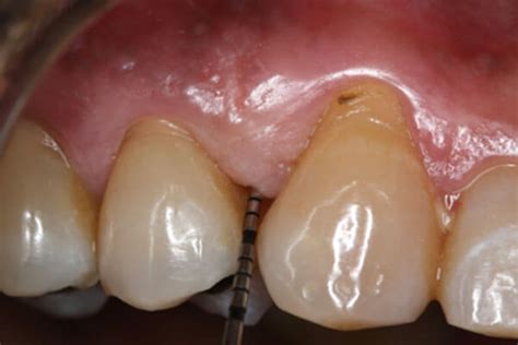 Stages of Periodontal Disease | Bayside Periodontics & Dental Implants