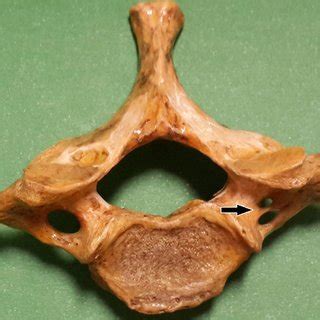 Double foramen transversarium. | Download Scientific Diagram