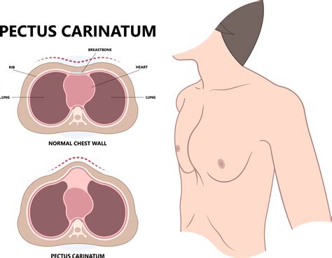 Pectus Carinatum - Hisar Intercontinental Hospital