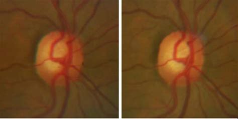 Evaluating the cup and disc in glaucoma - EyeGuru