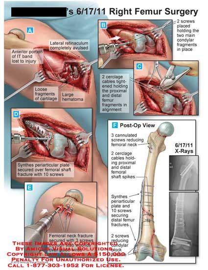 AMICUS Illustration of amicus,surgery,femur,IT,band,retinaculum,avulse,synthes,periarticular ...