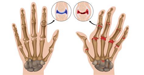 Rheumatism its types and causes | healthy care - healthy care