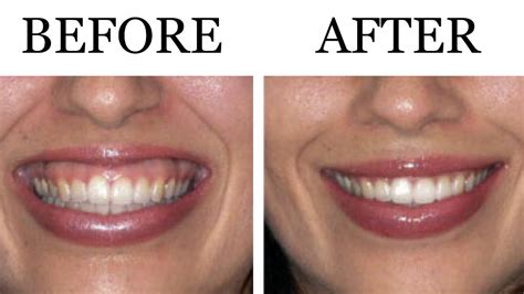 Gummy Smile Botox | lifestyle-solutions