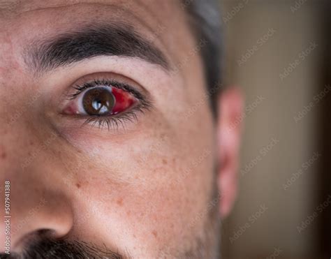 Subconjunctival hemorrhage on man eye. Bloody eye. Broken blood vessel ...