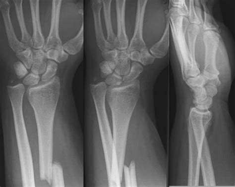 Galeazzi fracture • LITFL • Medical Eponym Library