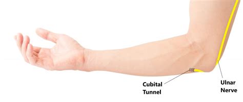 Cubital Tunnel Syndrome - My Family Physio