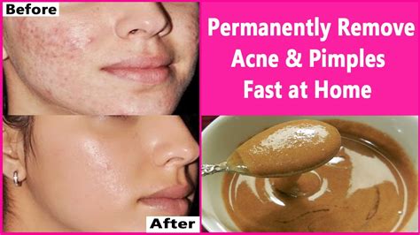 In 3 DAYS- Permanently Remove Acne & Pimples Fast at Home | Overnight Acne & Pimples Treatment ...