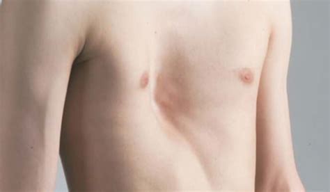 Pectus Excavatum - Western Toronto Thoracic Associates