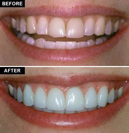 Composite Veneers Pros And Cons