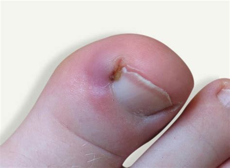 Ingrown Toenail - Davenport House Clinic