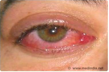 44 Top Pictures Corneal Ulcer Cat How Long To Heal : Using Bandage Contact Lenses For Dogs And ...