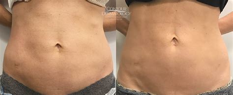 Velashape Before And After Abdomen