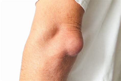 What is Olecranon Bursitis & How to Manage Elbow Pain? - Upswing Health