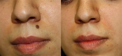 The Benefits of Mole Removal Surgery - Fallen Scoop