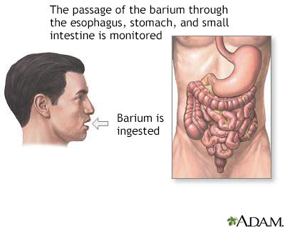 Upper GI and small bowel series Information | Mount Sinai - New York