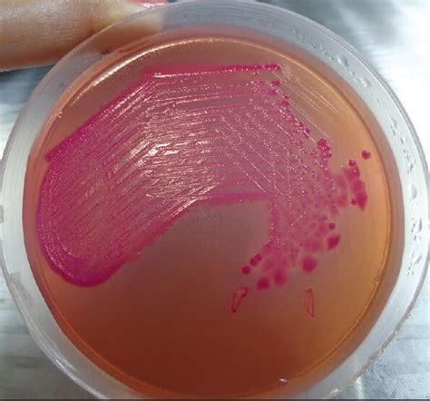 Acinetobacter baumannii- An Overview